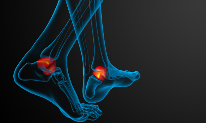 Pain location caused by Achilles tendonitis 
