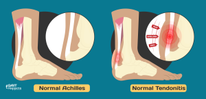 Diagram of Symptoms of Achilles Tendonitis