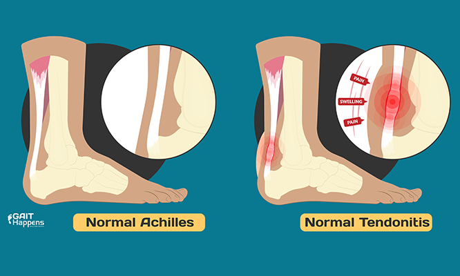 Anatomy of the Achilles Tendon