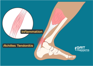 Using Symptoms for Diagnosing Achilles Tendonitis