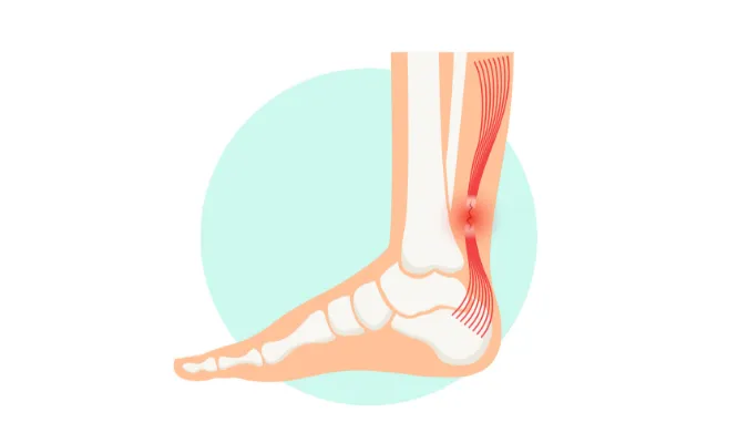 Achilles diagnosis picture