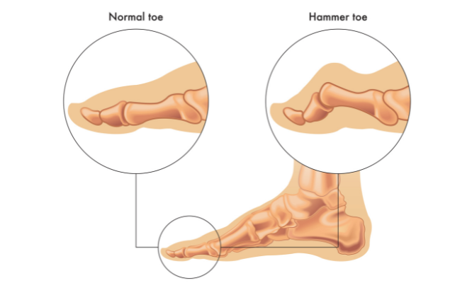 Diagram of the area affected by the hammertoes. 