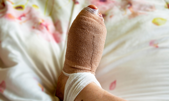 Surgical Treatments for Hammertoes. 