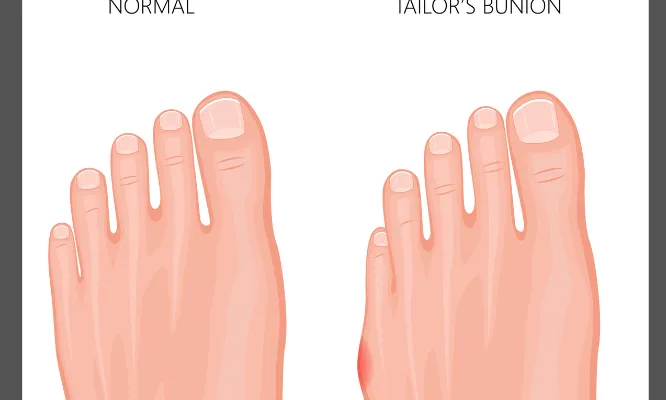 Tailor's bunions, also known as bunionettes, are a type of foot deformity that affects the joint at the base of the little toe
