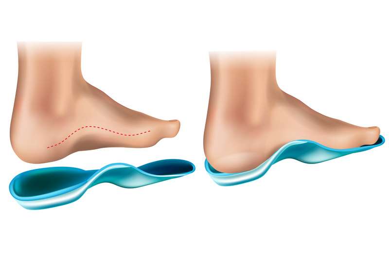 Short-Term-Use-of-Orthotics-for-Flat-Feet