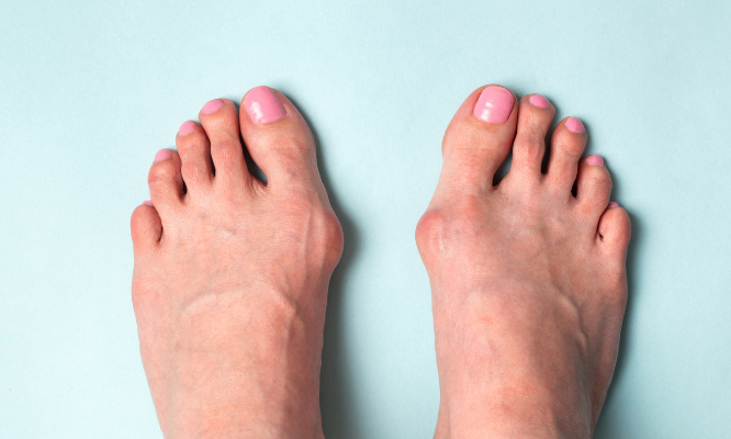 painful bunions