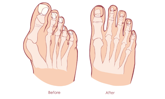 effective solutions for foot pain