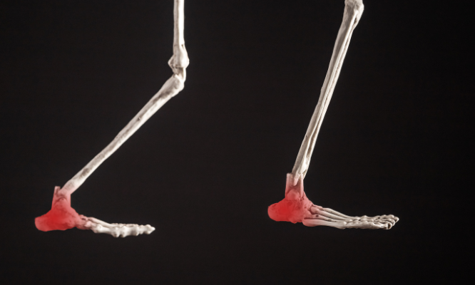 plantar fasciitis on the skeleton