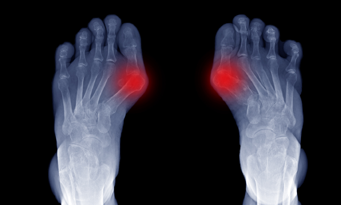 toe bunions symptoms