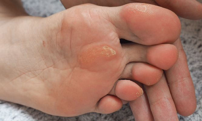 corns and calluses