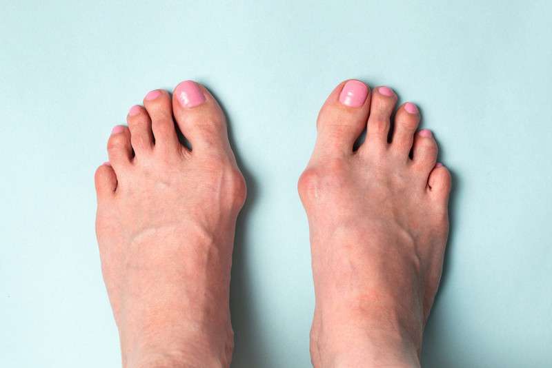 what are bunions