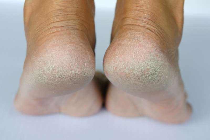 cracked heels and feet causes